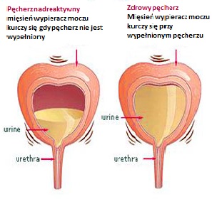Pęcherz nadreaktywny Pęcherz nadreaktywny